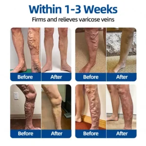 👩‍⚕️🎁 𝐅𝐥𝐨𝐫𝐢𝐬𝐦𝐚® ✅ 𝐕𝐞𝐢𝐧𝐓𝐚𝐫𝐠𝐞𝐭 𝐌𝐢𝐜𝐫𝐨𝐧𝐞𝐞𝐝𝐥𝐞 𝐏𝐚𝐭𝐜𝐡⚡Instant Relief, Long-Term Results